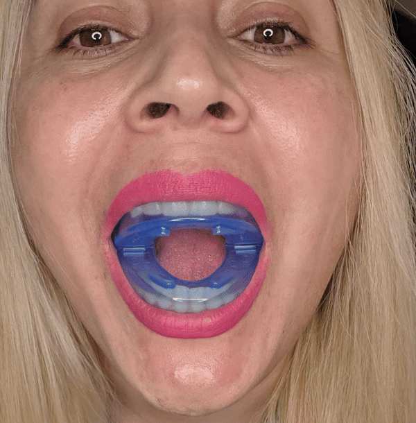 Dispozitiv nocturn anti-sforăit și anti-scrâșnit